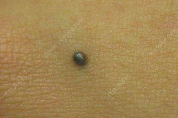 除黑痣的方法有哪些？黑痣都有哪些種類？(2)