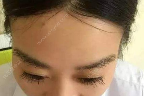 為什么發(fā)際線越來越高？發(fā)際線高該怎么辦？(2)