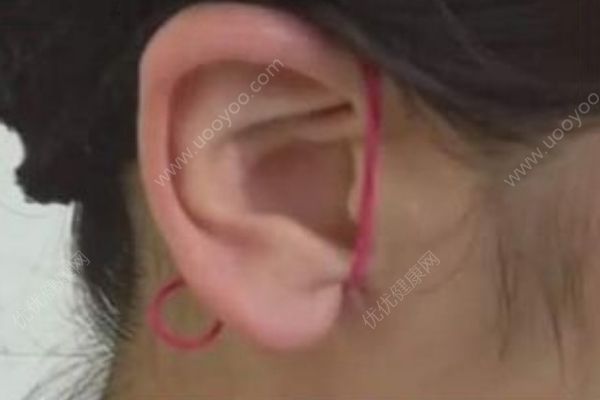 橡皮筋瘦臉法真的有效嗎？橡皮筋瘦臉法是怎樣的？(2)