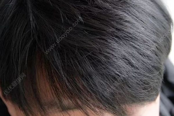 頭發(fā)洗了一兩天就出油怎么辦？頭發(fā)如何控油效果好？(2)