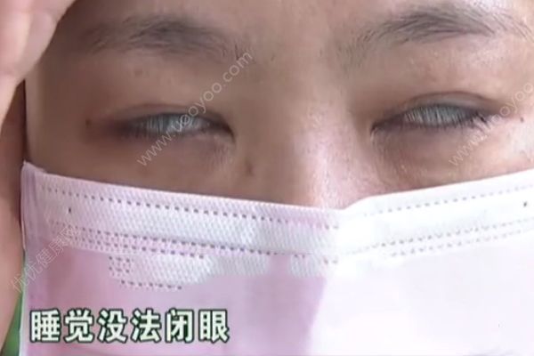 女子做整容手術(shù)后眼睛無法合上！睡覺只能翻白眼貼膠帶！(2)