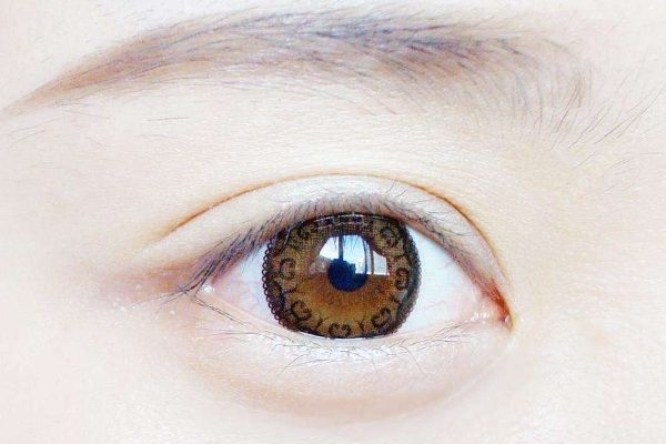 女子高中時(shí)開始戴美瞳，十年下來兩眼的角膜嚴(yán)重缺氧(3)