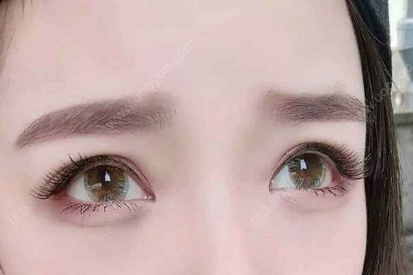 女子高中時(shí)開始戴美瞳，十年下來兩眼的角膜嚴(yán)重缺氧(4)