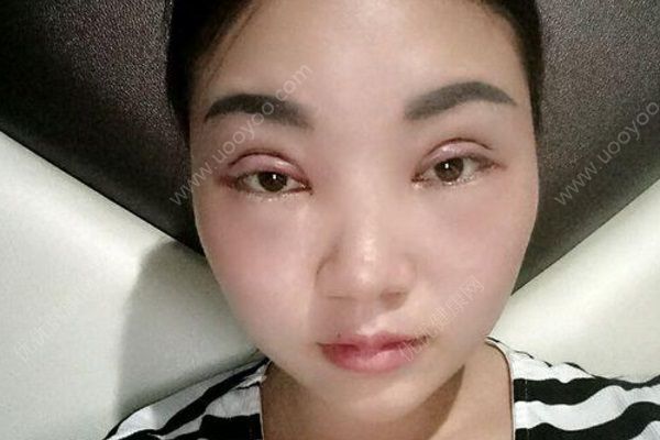 女子花5300元割雙眼皮，3年后想退款：左眼是四眼皮(4)