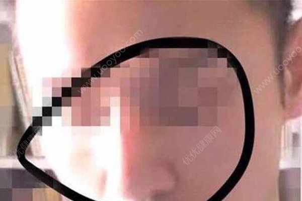 男子不滿隆鼻效果畫符扎娃娃詛咒，醫(yī)院：無理取鬧(1)