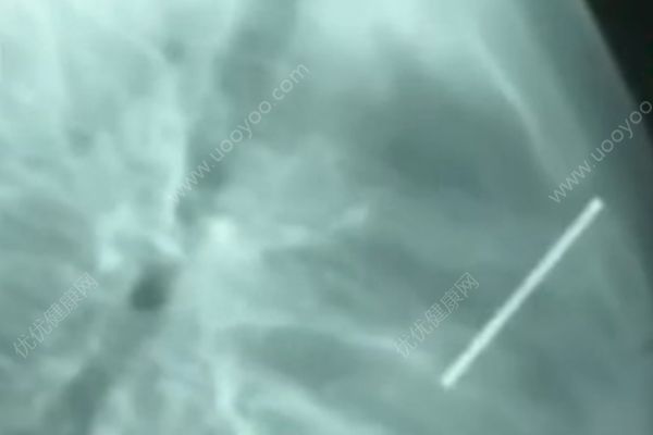 兩歲男童誤把射釘槍當玩具，釘子穿透肺險喪命(3)
