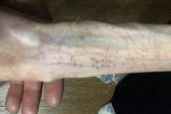 21歲女孩減肥至50斤，2次腦出血腦組織如60歲(2)