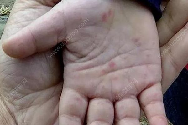 女嬰手臂一夜間變黑壞死生命垂危，原是被細(xì)菌吃掉了！(3)