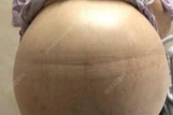 69歲大媽患婦科腫瘤肚鼓如球，醫(yī)生抽出30多升囊液(2)