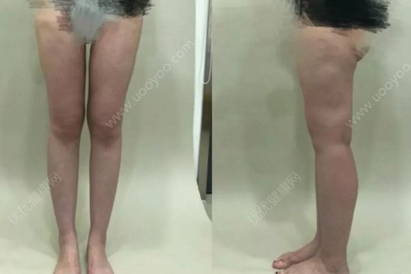 23歲女子花1萬(wàn)5做腿部吸脂術(shù)，半年后腿上全是坑(1)