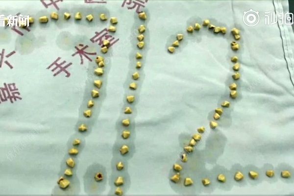 每天吃個鵝蛋，兩年后體內取出80多顆結石(1)