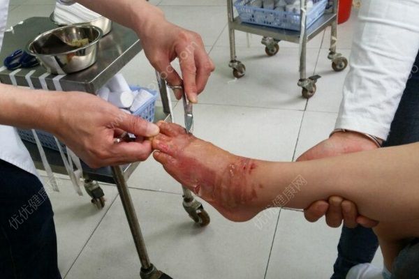3歲男童被開(kāi)水燙傷，外婆憑經(jīng)驗(yàn)傷口撒鹽加重傷勢(shì)(3)