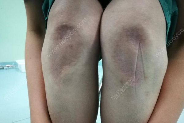 為救護(hù)士腿部跪出青紫，家人曾一度想放棄(2)