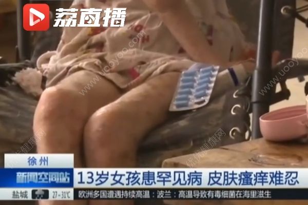 女孩患罕見(jiàn)病最怕熱，家貧買不起空調(diào)只靠奶奶背起來(lái)回走(3)
