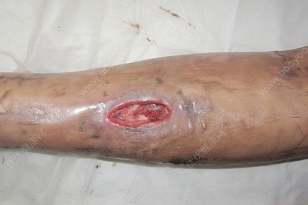 男子殺魚(yú)時(shí)不小心劃傷手指，幾個(gè)月后右手手臂被