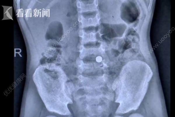 7歲男孩腹痛近1周，醫(yī)生取出8厘米棒棒糖棍子(2)