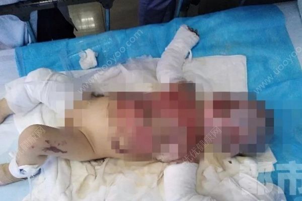 電動(dòng)車撞翻早餐攤油鍋，1歲半男娃被熱油從頭澆下(2)