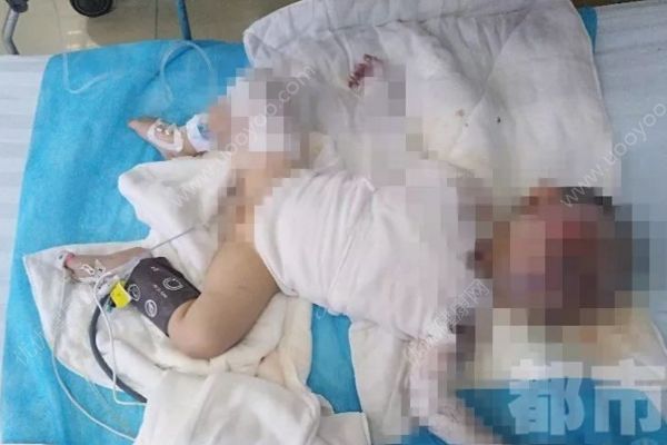 電動(dòng)車撞翻早餐攤油鍋，1歲半男娃被熱油從頭澆下(4)