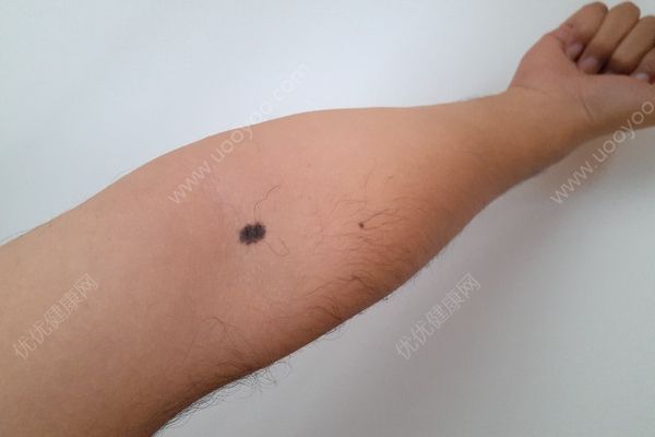 摳破黑痣，20歲小伙罹患惡性腫瘤險(xiǎn)喪命(1)