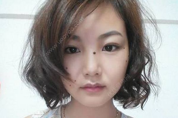 摳破黑痣，20歲小伙罹患惡性腫瘤險(xiǎn)喪命(3)