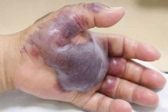 韓國男子吃生魚壽司感染細菌，一條手臂被截肢[多圖]
