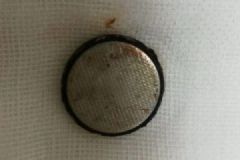 2歲男童誤吞電池近20天卻當(dāng)胃病醫(yī)，取出已嚴(yán)重腐蝕[多圖]