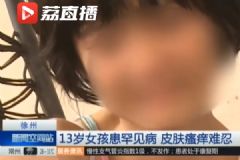 女孩患罕見病最怕熱，家貧買不起空調(diào)只靠奶奶背起來回走[多圖]