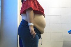 女學生肚子內(nèi)藏巨大包塊，囊液相當于24瓶礦泉水[多圖]