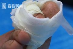 女子被毒蟲叮咬不以為意，誰(shuí)知腳趾潰爛險(xiǎn)些截趾[多圖]