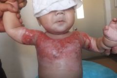 3歲男童被開水燙傷，外婆憑經(jīng)驗(yàn)傷口撒鹽加重傷勢[多圖]