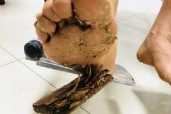 女子穿拖鞋晨跑腳底扎進(jìn)生銹鐵釘板，若治療不當(dāng)有生命危險(xiǎn)[多圖]