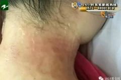 女子在美容院拔火罐聞到烤肉味，是自己脖子發(fā)出的[多圖]
