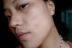 臉上長痘痘吃中藥有用嗎？臉上長痘痘為什么吃中藥？[多圖]