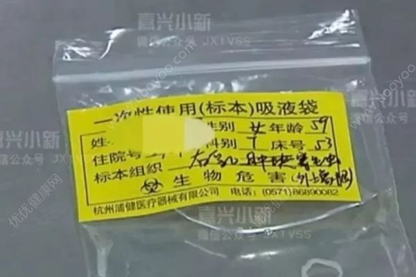女子體內(nèi)取出13厘米長的活蟲！這種傻事可別再做了(2)