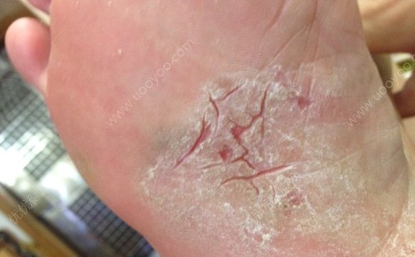 腳底裂開是什么原因？腳底裂開了口子怎么辦？(1)