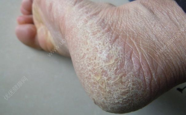 腳底裂開是什么原因？腳底裂開了口子怎么辦？(2)