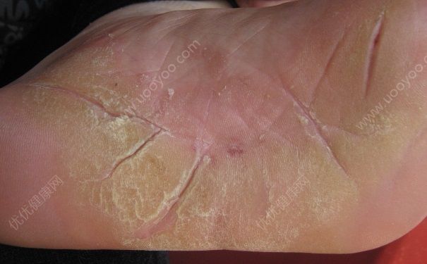 腳底裂開是什么原因？腳底裂開了口子怎么辦？(3)