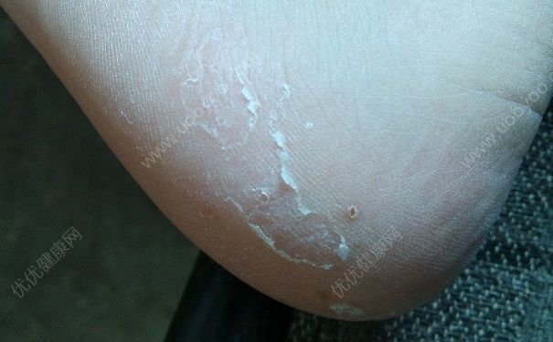 腳底裂開是什么原因？腳底裂開了口子怎么辦？(4)