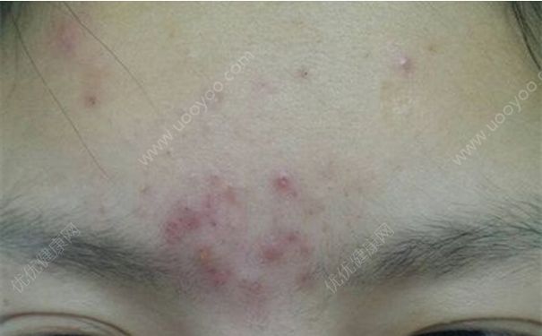 眉心長痘痘是什么原因？眉心長痘痘怎么辦？(1)