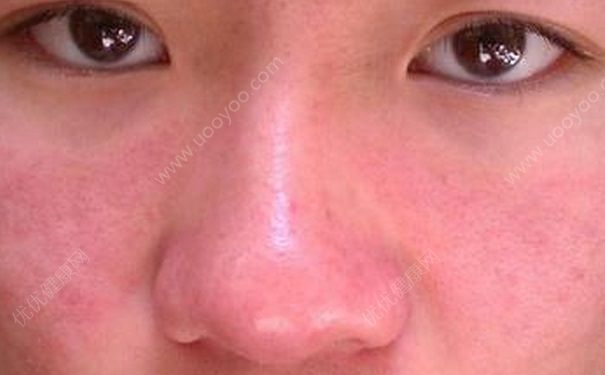 洗面奶會(huì)過敏嗎？洗面奶會(huì)使毛孔變大嗎？(2)
