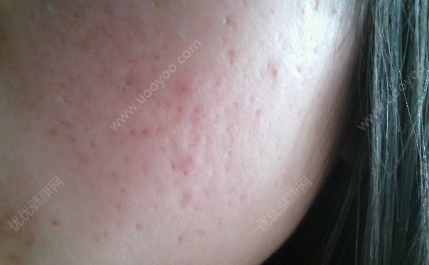 蘆薈膠可以去痘印嗎？蘆薈膠去痘印有效嗎？(2)