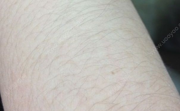 光子嫩膚可以脫毛嗎？光子嫩膚能脫毛嗎？(1)