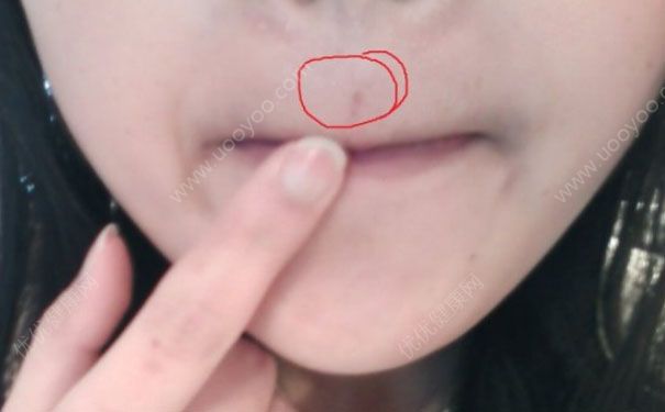 人中長痘怎么辦？人中長痘怎么消除？(1)