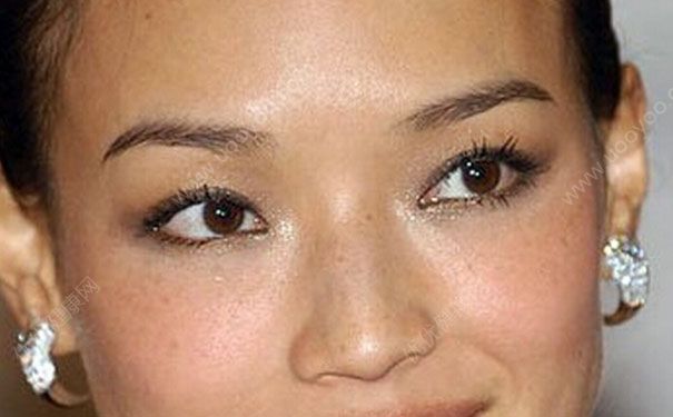 黃褐斑如何徹底治療？黃褐斑如何去除？(2)