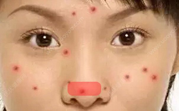 鼻子上長(zhǎng)痘痘怎么辦？鼻子上長(zhǎng)痘痘怎么去掉？(6)