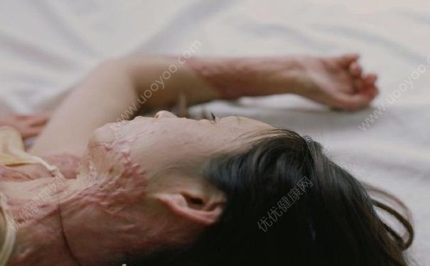 毀容少女曬寫真 毀容后如何樂(lè)觀生活？(4)