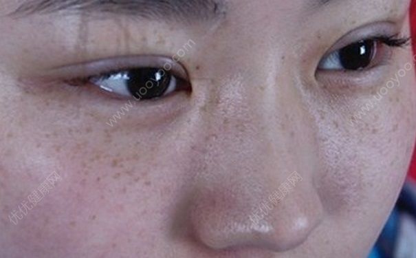 雀斑是怎么形成的？雀斑可以去掉嗎？(2)