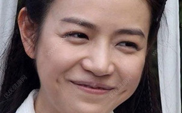 臉胖是什么原因引起的？臉胖是怎么回事？(1)