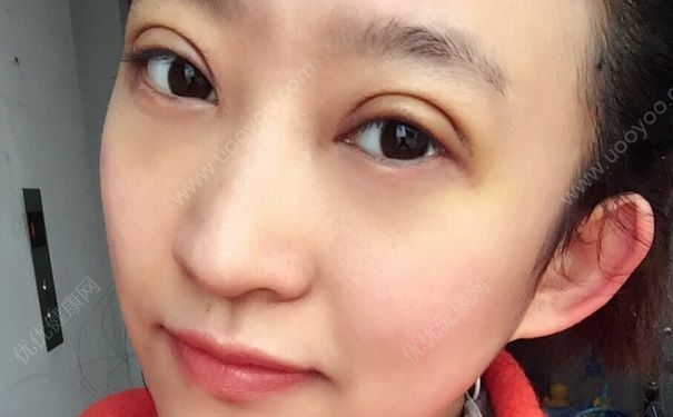 割雙眼皮后注意些什么？割雙眼皮后的注意事項(1)