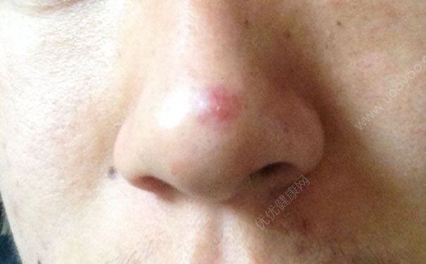 鼻梁上長痘痘是什么原因？鼻梁上長痘痘怎么消除？(1)